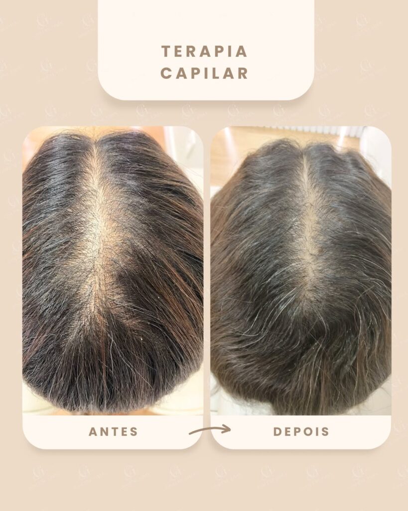 Antes e depois de tratamento da calvície: redução de falhas na raiz