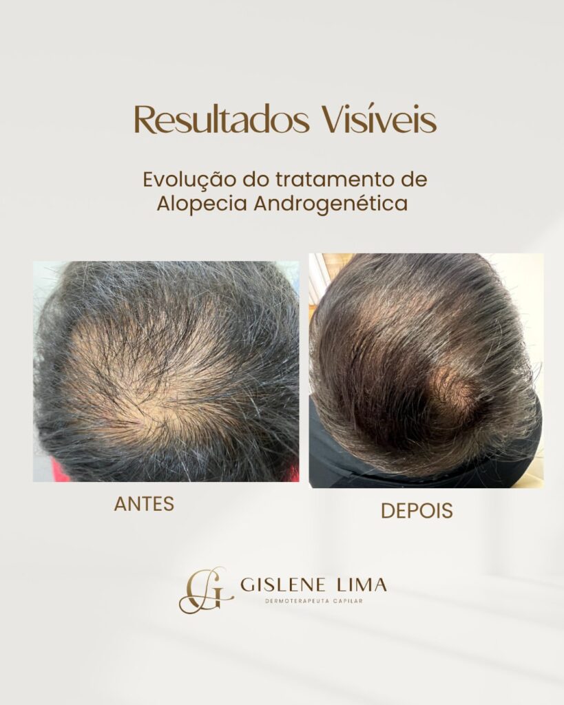 Evolução do tratamento de alopecia androgenética com tricologia clínica