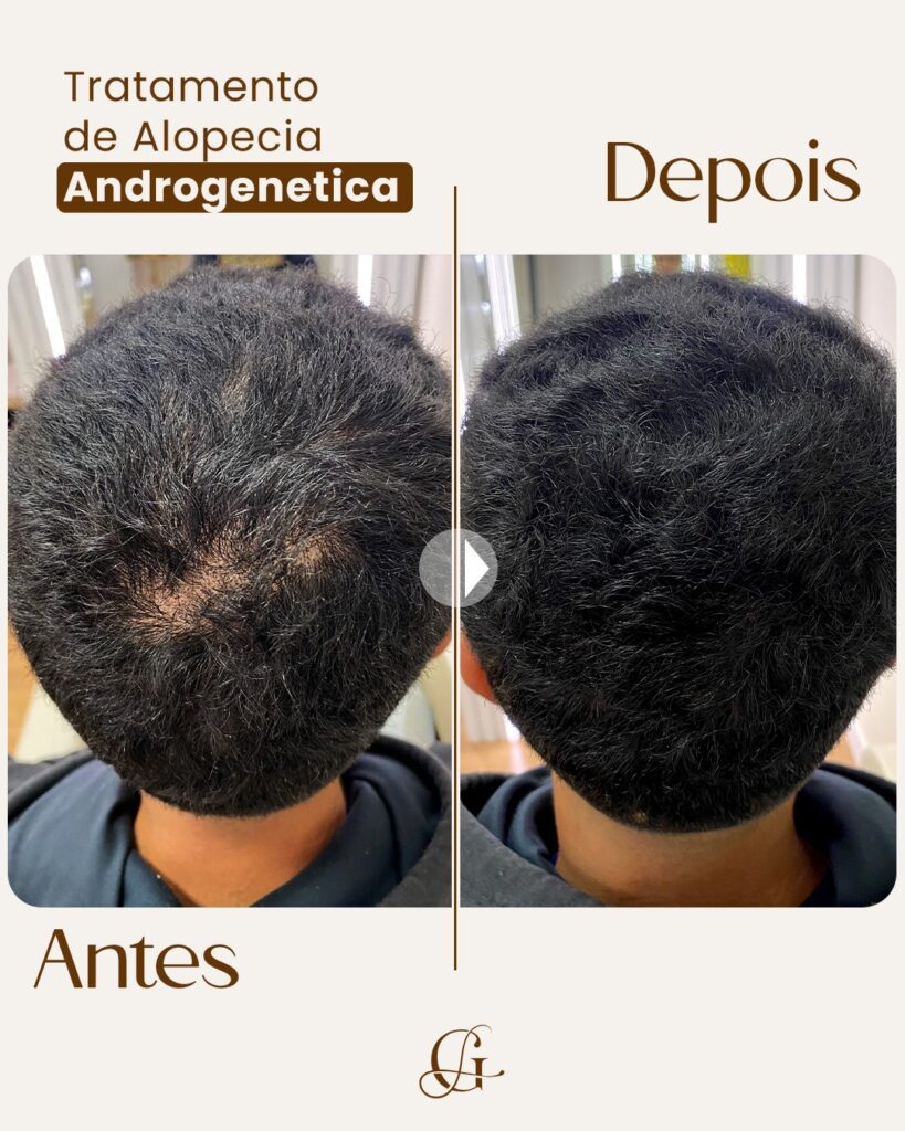 Tratamento de alopecia androgenética: antes e depois