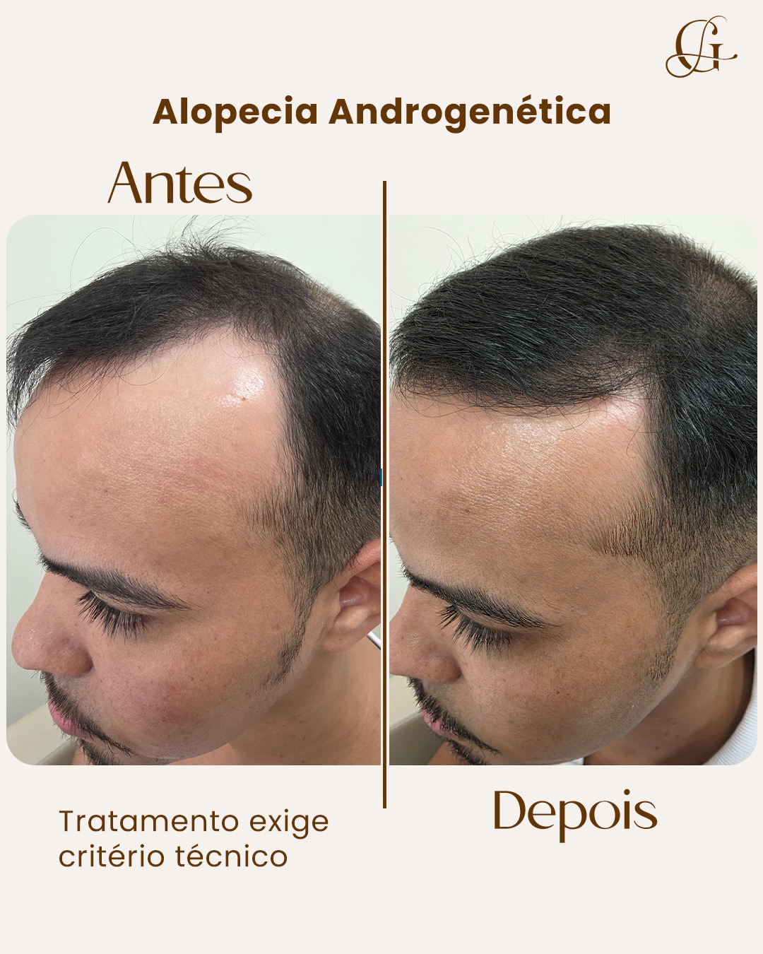 Antes e depois de tratamento de alopecia androgenética com Gislene Lima, tricologista em Belo Horizonte